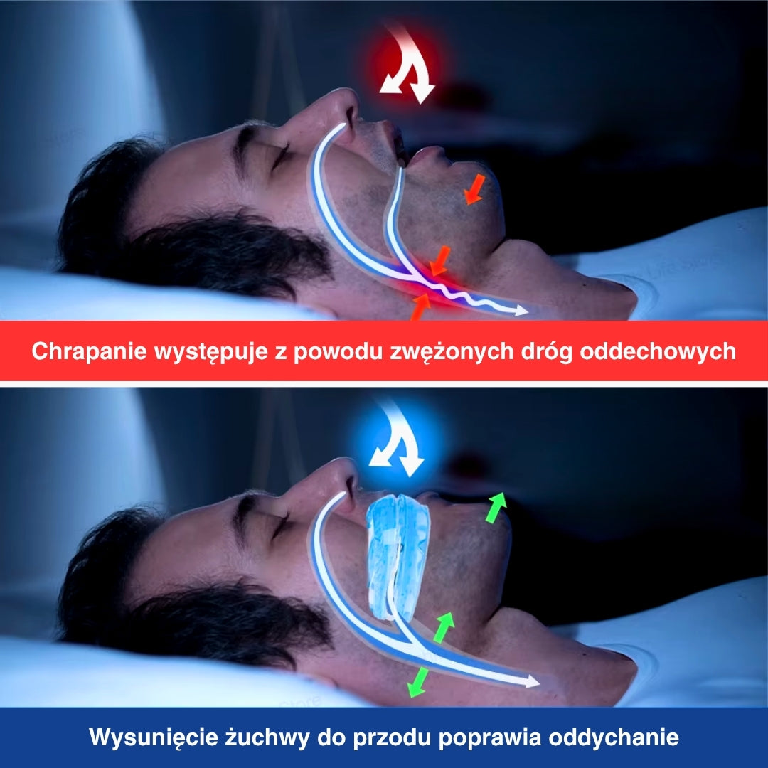 Bocchino regolabile contro il russare per un sonno e una respirazione migliori