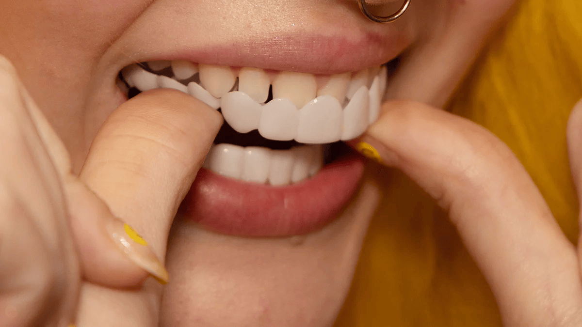 Okamžitá hmota na kozmetické prekrytie zubov a krajší úsmev